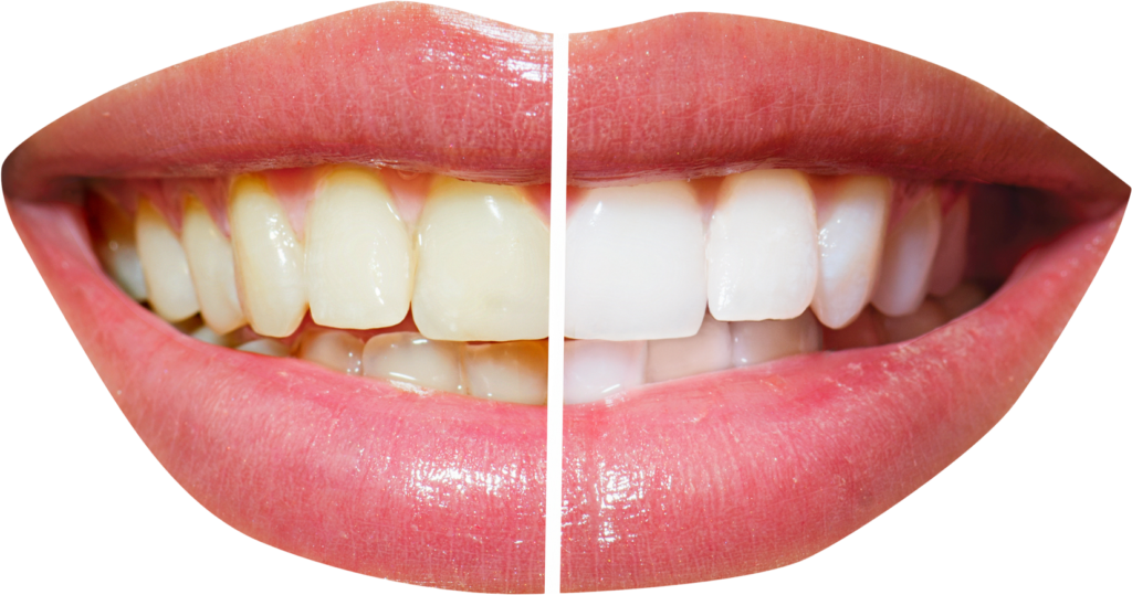 teeth whitening home and laser and zoom